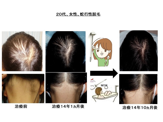 円形脱毛症　病院